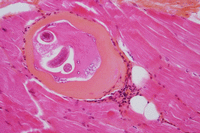 Biopsie musculaire avec larves de Trichinella